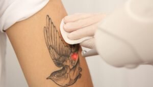 How to Avoid Scarring from Tattoo Removal